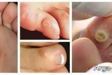 درمان خانگی میخچه