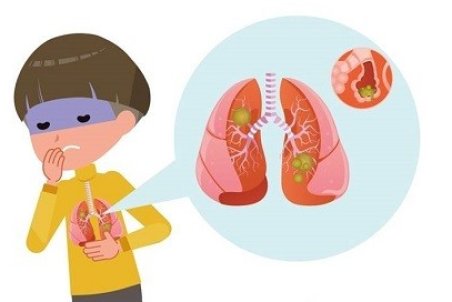 سینه پهلو یا ذات الریه در کودکان : همه آنچه باید بدانید