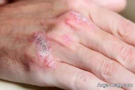 درمان عفونت پوستی و دلایل بروز آن چیست؟