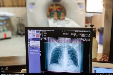 علائم درگیری ریه در مبتلایان کرونا چیست؟