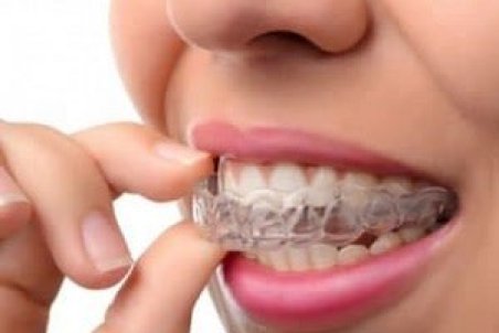 همه چیز در مورد ارتودنسی نامرئی