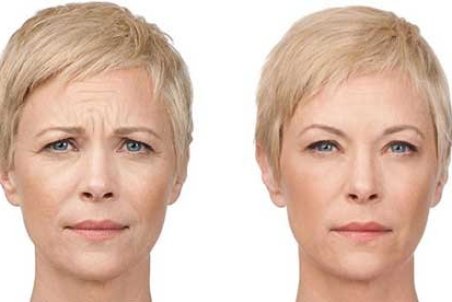 روش های از بین بردن خط اخم و چروک پیشانی