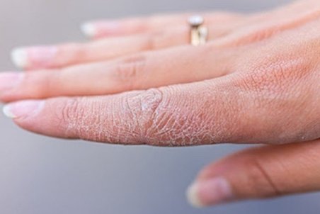 علل خشکی پوست و شیوه‌های درمان آن