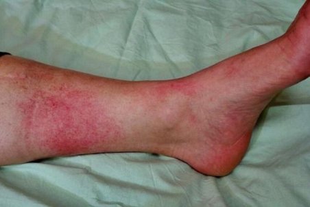 علائم بیماری قرمزی پوست