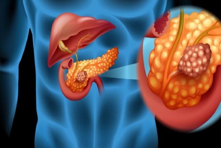 علائم سرطان پانکراس که از آنها بی‌اطلاع هستید
