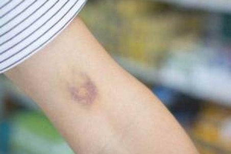 هر رنگ کبودی روی بدن نشانه چیست ؟