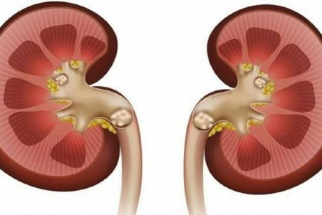 علائم رایج سنگ کلیه چیست؟