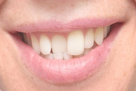 رعب آورترین عوارض تراکم و فشردگی دندان‌ها به یکدیگر