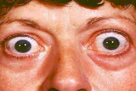 بیماری تیروئید چشمی و علائم آن