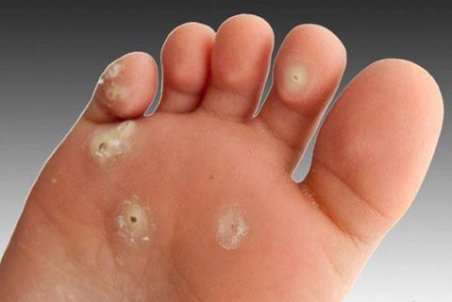 دلیل ایجاد میخچه چیست؟ + درمان خانگی