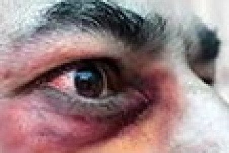 چکار کنیم به «قارچ سیاه» مبتلا نشویم؟