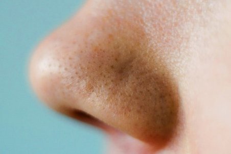 رفع سریع نقطه های سرسیاه روی بینی