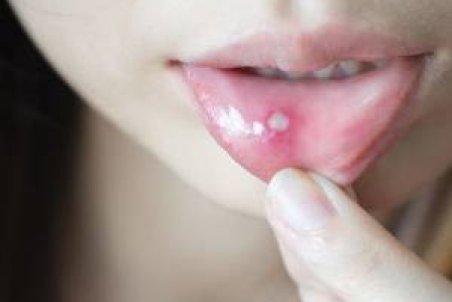 علت ، علائم و درمان سریع آفت دهان و زبان