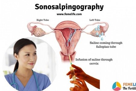 سونوهیستروگرافی چیست و چگونه انجام می شود؟