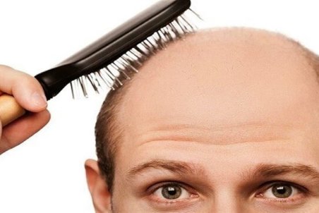 کمبودی در بدن که عامل ریزش مو است