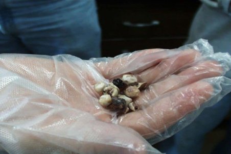 علائم "سنگ کیسه صفرا" چیست + راهکار درمانی طب سنتی