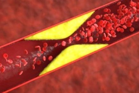 علائم وجود لخته خون در بدن