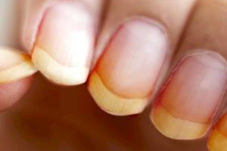چگونه زردی ناخن را از بین ببریم و درمان کنیم؟