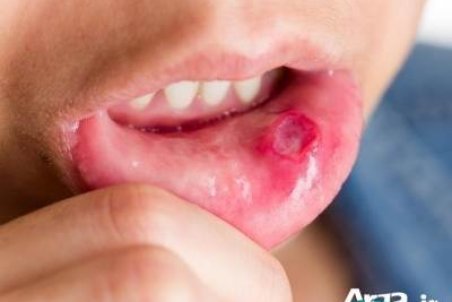 چرا دهان شما آفت می زند؟