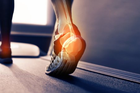 علت درد پاشنه پا هنگام راه رفتن