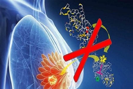 چاقی و کم‌تحرکی زمینه‌ساز بروز سرطان پستان در بانوان است