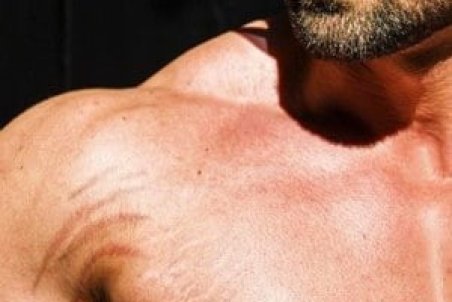 از بین بردن ترک های پوستی