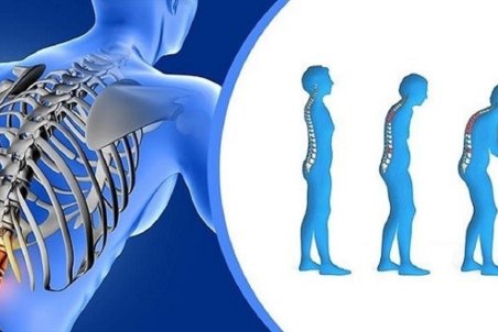 پوکی استخوان، بیماری خاموش و خطرناک اما قابل پیشگیری