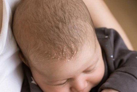 بیماری درماتیت سبورئیک نوزادان و راه های درمان آن