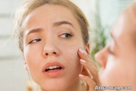 علت خشکی پوست در زمستان