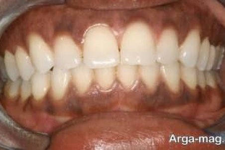 آشنایی با روش های درمان خانگی لثه سیاه