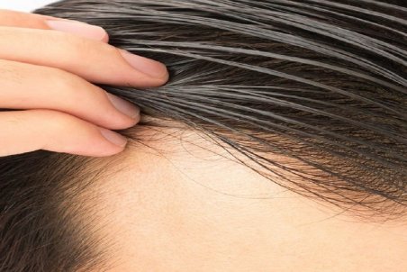 علت چرب شدن موی سر چیست؟