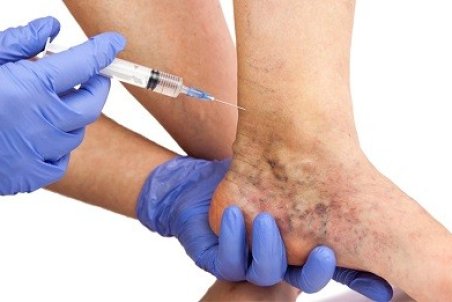 نحوه انجام اسکلروتراپی واریس + مراقبتهای بعد از اسکلروتراپی واریس پا