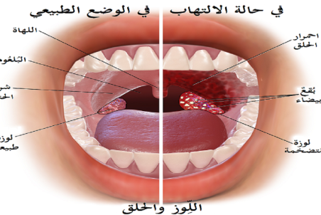 درمان قطعی التهاب لوزه با بد بوی پرخاصیت