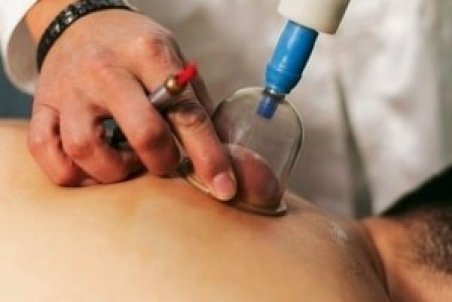 14 مزایای ناشناخته بادکش درمانی برای سلامتی