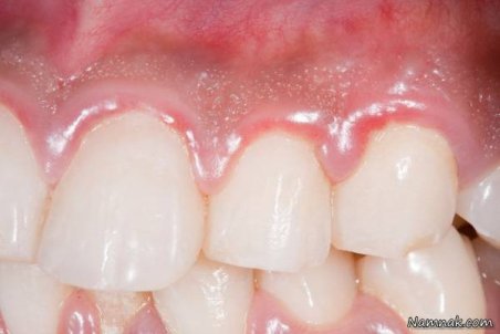 چرا لثه ورم می کند ؟ علت تورم لثه چیست؟