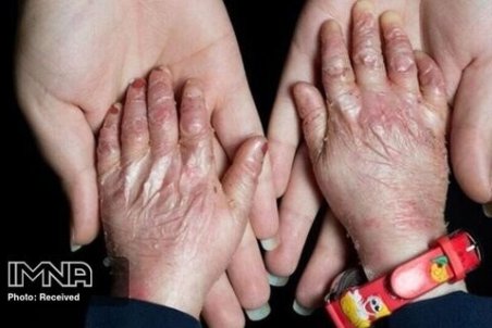 پانسمان بیماران پروانه‌ای مفقود نشده است