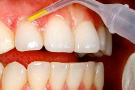 درمان گیاهی عفونت لثه