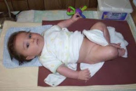 ادرار سوختگی کودکتان را درمان کنید!