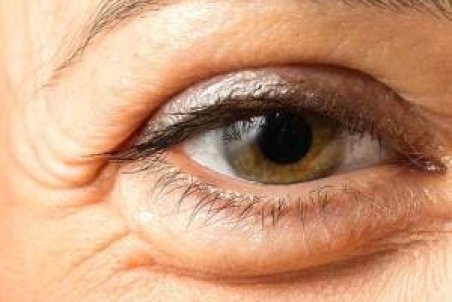 دلایل پف چشم و راه های ساده درمان آن