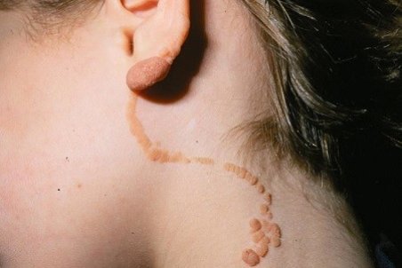 خال اپیدرمال چیست؟