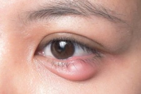 تمام علل و راه های درمان خانگی گل مژه