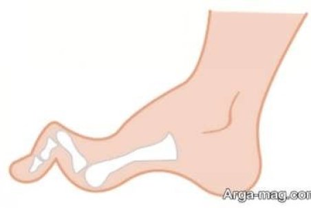 دلیل انگشت چکشی پا و نحوه درمان آن