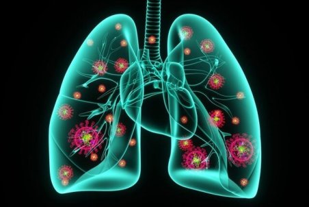 ذات‌الریه و کرونا دو بیماری با علائم یکسان