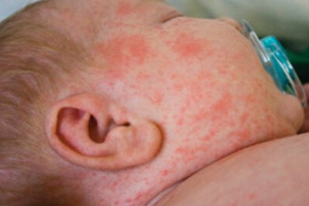 مورد مشکوکی از ابتلا به سرخک در اصفهان نداشتیم/پوشش ۹۵درصدی واکسیناسیون سرخک