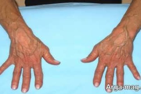 آشنایی با دلیل بیرون زدگی رگ ها