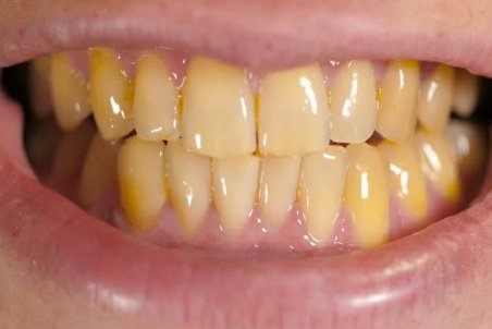 چرا دندان‌ها زرد می‌شوند؟