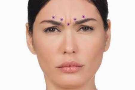 طریقه انجام عمل زیبایی خط اخم بین دو ابرو