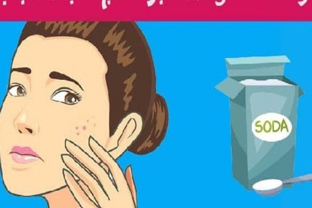 فواید جوش شیرین برای رفع آکنه