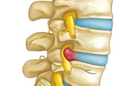 پارگی دیسک کمر چیست و چگونه درمان می شود؟