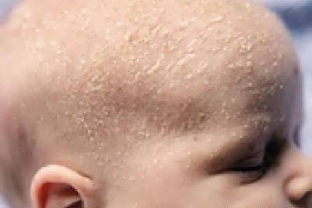دلیل پوسته ریزی سر نوزاد چیست؟ و برای درمان آن چه کنیم؟